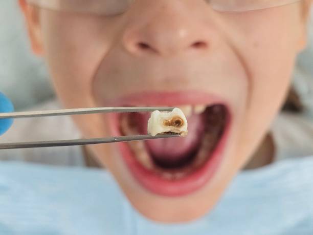 Best Emergency Dental Care for Broken or Chipped Teeth in Oelwein, IA